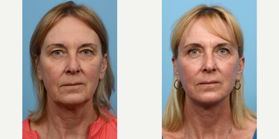 Case 11210 - 55-64 year old woman treated with Laser Resurfacing