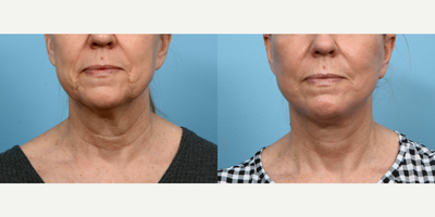 Case 11211 - 55-64 year old woman treated with CO2 Laser