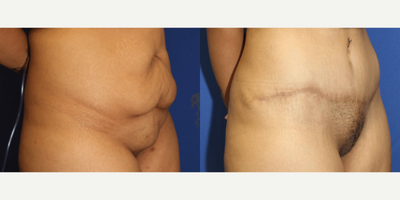 Case 1122 - Woman treated with Tummy Tuck