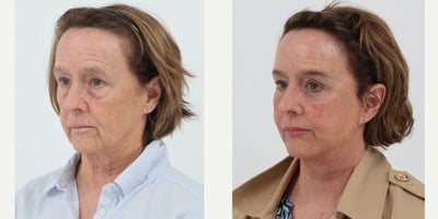 Case 11220 - 65-74 year old woman treated with Facelift, Neck Lift, Brow Lift, Eyelid Surgery, Facial Fat Transfer, CO2 Laser