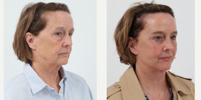 Case 11221 - 65-74 year old woman treated with Facelift, Neck Lift, Brow Lift, Eyelid Surgery, Facial Fat Transfer, CO2 Laser