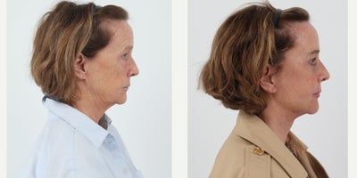 Case 11223 - 65-74 year old woman treated with Facelift, Neck Lift, Brow Lift, Eyelid Surgery, Facial Fat Transfer, CO2 Laser