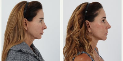 Case 11227 - 55-64 year old woman treated with Facelift, Neck Lift, Facial Fat Transfer, CO2 Laser