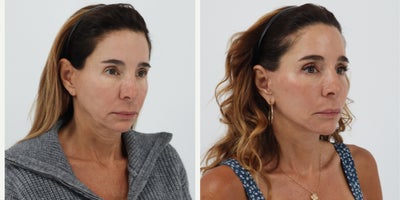 Case 11228 - 55-64 year old woman treated with Facelift, Neck Lift, Facial Fat Transfer, CO2 Laser
