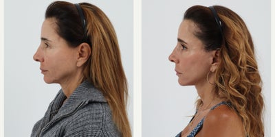 Case 11229 - 55-64 year old woman treated with Facelift, Neck Lift, Facial Fat Transfer, CO2 Laser