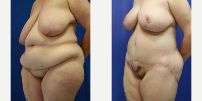 Case 1123 - 35-44 year old woman treated with Tummy Tuck