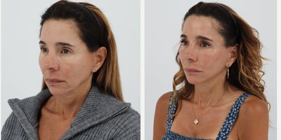 Case 11230 - 55-64 year old woman treated with Facelift, Neck Lift, Facial Fat Transfer, CO2 Laser