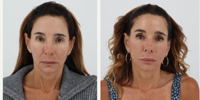 Case 11231 - 55-64 year old woman treated with Facelift, Neck Lift, Facial Fat Transfer, CO2 Laser