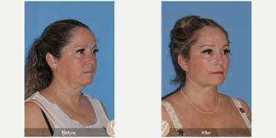 Case 11232 - 45-54 year old woman treated with Deep Plane Facelift, Neck Lift, Brow Lift, CO2 Laser, MACS Facelift