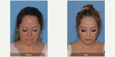 Case 11234 - 45-54 year old woman treated with Deep Plane Facelift, Neck Lift, Brow Lift, CO2 Laser, MACS Facelift