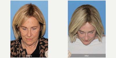 Case 11236 - 68 year old woman treated with Deep Plane Facelift, Neck Lift, Brow Lift, CO2 Laser, MACS Facelift