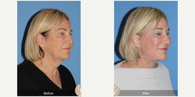 Case 11238 - 68 year old woman treated with Deep Plane Facelift, Neck Lift, Brow Lift, CO2 Laser, MACS Facelift