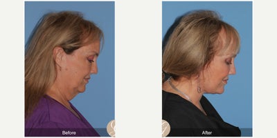 Case 11239 - 66 year old woman treated with Deep Plane Facelift, Neck Lift, Eyelid Surgery, CO2 Laser, MACS Facelift