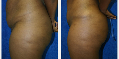 Case 1124 - 35-44 year old woman treated with Tummy Tuck