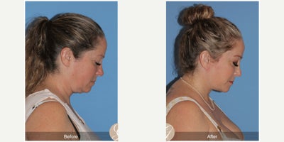Case 11240 - 45-54 year old woman treated with Deep Plane Facelift, Neck Lift, Brow Lift, CO2 Laser, MACS Facelift