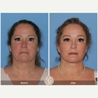 Case 11241 - 45-54 year old woman treated with Deep Plane Facelift, Neck Lift, Brow Lift, CO2 Laser, MACS Facelift