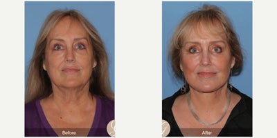Case 11242 - 66 year old woman treated with Deep Plane Facelift, Neck Lift, Eyelid Surgery, CO2 Laser, MACS Facelift