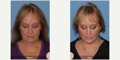 Case 11243 - 66 year old woman treated with Deep Plane Facelift, Neck Lift, Eyelid Surgery, CO2 Laser, MACS Facelift