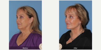Case 11244 - 66 year old woman treated with Deep Plane Facelift, Neck Lift, Eyelid Surgery, CO2 Laser, MACS Facelift