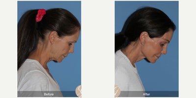 Case 11247 - 57 year old woman treated with Deep Plane Facelift, Facelift, Neck Lift, Brow Lift, Facial Fat Transfer, Lip Lift, CO2 Laser, Bo