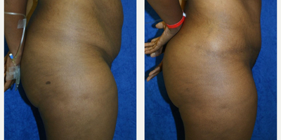 Case 1125 - 35-44 year old woman treated with Tummy Tuck