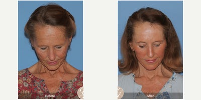 Case 11250 - 69 year old woman treated with Deep Plane Facelift, Facelift, Neck Lift, Brow Lift, CO2 Laser, Eyelid Surgery, Botox