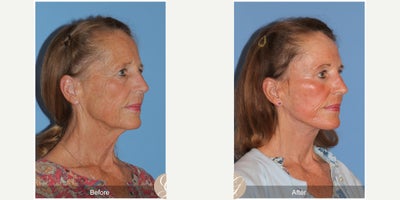 Case 11251 - 69 year old woman treated with Deep Plane Facelift, Facelift, Neck Lift, Brow Lift, CO2 Laser, Eyelid Surgery, Botox