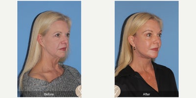 Case 11255 - 63 year old woman treated with Deep Plane Facelift, Facelift, Neck Lift, Brow Lift, Eyelid Surgery, CO2 Laser, MACS Facelift