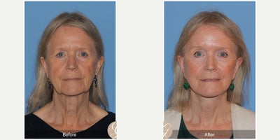 Case 11257 - 72 year old woman treated with Deep Plane Facelift, Facelift, Neck Lift, Brow Lift, CO2 Laser