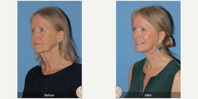 Case 11258 - 72 year old woman treated with Deep Plane Facelift, Facelift, Neck Lift, Brow Lift, CO2 Laser