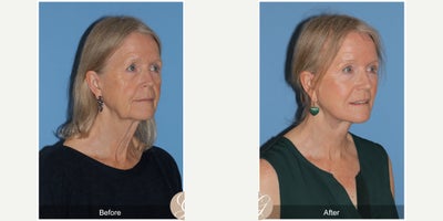 Case 11259 - 72 year old woman treated with Deep Plane Facelift, Facelift, Neck Lift, Brow Lift, CO2 Laser