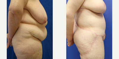 Case 1126 - 35-44 year old woman treated with Tummy Tuck