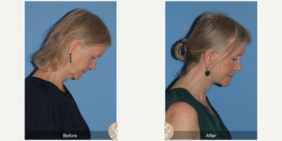 Case 11260 - 72 year old woman treated with Deep Plane Facelift, Facelift, Neck Lift, Brow Lift, CO2 Laser