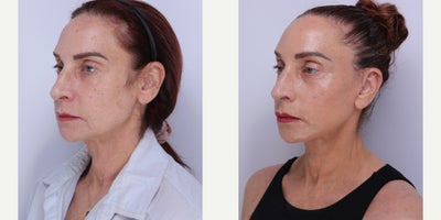 Case 11263 - 55-64 year old woman treated with Facelift, Neck Lift, Brow Lift, Facial Fat Transfer, CO2 Laser