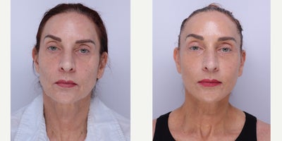 Case 11264 - 55-64 year old woman treated with Facelift, Neck Lift, Brow Lift, Facial Fat Transfer, CO2 Laser