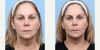 Case 11265 - 55-64 year old woman treated with Facelift, Deep Plane Facelift, Eyelid Surgery, Double Eyelid Surgery, Facial Fat Transfer, CO2