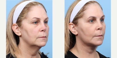 Case 11266 - 55-64 year old woman treated with Facelift, Deep Plane Facelift, Eyelid Surgery, Double Eyelid Surgery, Facial Fat Transfer, CO2