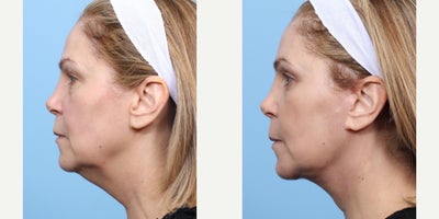 Case 11267 - 55-64 year old woman treated with Facelift, Deep Plane Facelift, Eyelid Surgery, Double Eyelid Surgery, Facial Fat Transfer, CO2