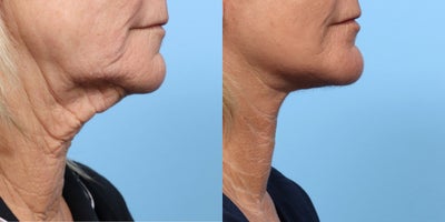 Case 11268 - 55-64 year old woman treated with Deep Plane Facelift, Facelift, CO2 Laser, Neck Lift