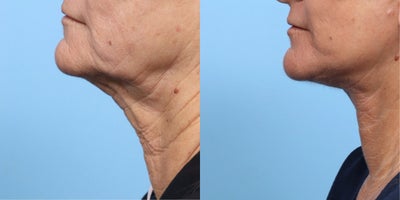 Case 11269 - 55-64 year old woman treated with Deep Plane Facelift, Facelift, CO2 Laser, Neck Lift