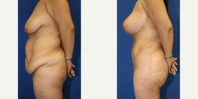 Case 1127 - 35-44 year old woman treated with Tummy Tuck