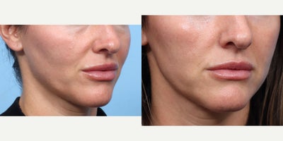 Case 11270 - 35-44 year old woman treated with Eyelid Surgery, CO2 Laser