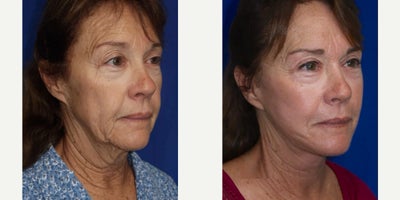 Case 11271 - 67 year old woman treated with Facelift, Neck Lift, Eyelid Surgery, CO2 Laser