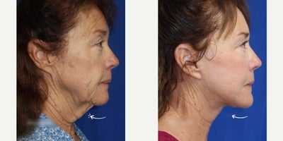 Case 11272 - 67 year old woman treated with Facelift, Neck Lift, Eyelid Surgery, CO2 Laser