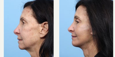 Case 11273 - 65-74 year old woman treated with Chin Implant, CO2 Laser, Deep Plane Facelift