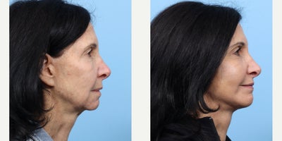 Case 11274 - 65-74 year old woman treated with Chin Implant, CO2 Laser, Deep Plane Facelift