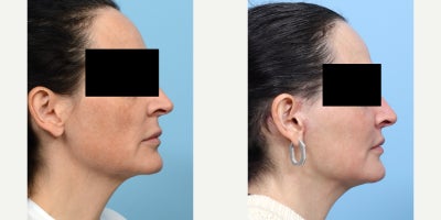 Case 11275 - 55-64 year old woman treated with Deep Plane Facelift, Facial Fat Transfer, CO2 Laser, Lip Lift