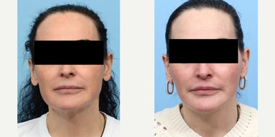 Case 11276 - 55-64 year old woman treated with Deep Plane Facelift, Facial Fat Transfer, CO2 Laser, Lip Lift