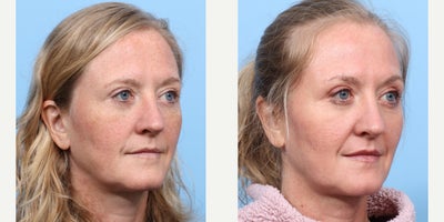 Case 11277 - 45-54 year old woman treated with CO2 Laser