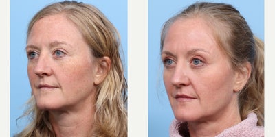 Case 11278 - 45-54 year old woman treated with CO2 Laser